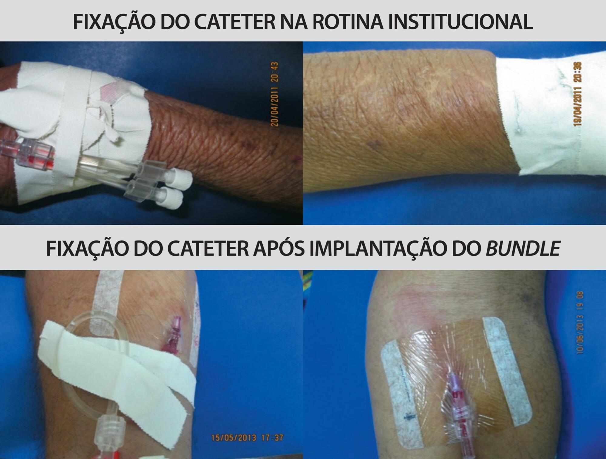 Protocolo de enfermagem na prevenção de trauma vascular: bundle de cateterismo periférico em urgência