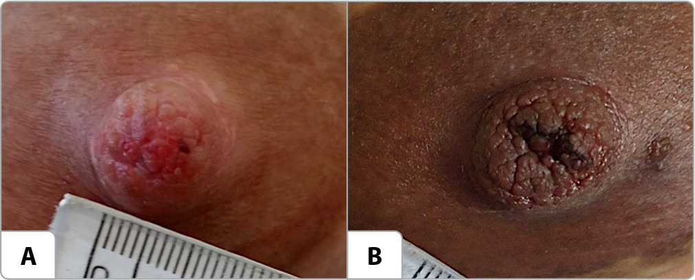 Initial nipple damages in breastfeeding women: analysis of photographic images and clinical associations