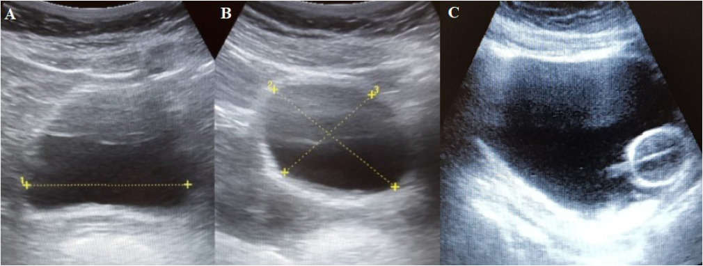 Bladder ultrasound: evidence of content validity of a checklist for training nurses